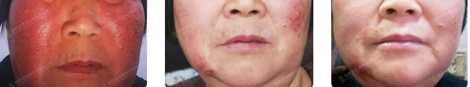 干細胞美容_美容細胞_美容干細胞有副作用嗎
