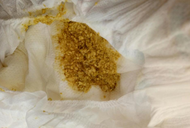 大便出血血液包裹大便_拉粑粑帶著血_寶媽拉大便帶血是什么情況