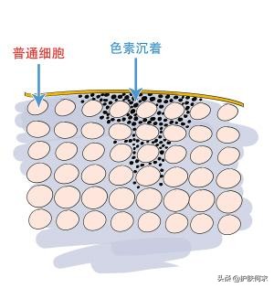 美白袪斑_美白淡斑最簡單的方法_斑淡化最有效的方法