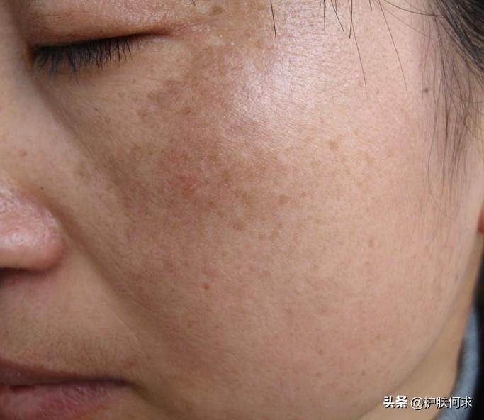 斑淡化最有效的方法_美白淡斑最簡單的方法_美白袪斑