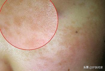 斑淡化最有效的方法_美白袪斑_美白淡斑最簡單的方法